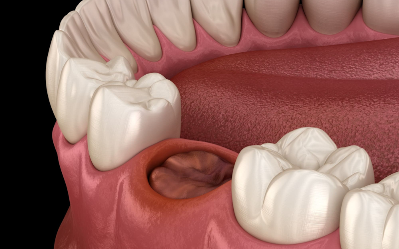 top factors that increase your risk of dry sockets