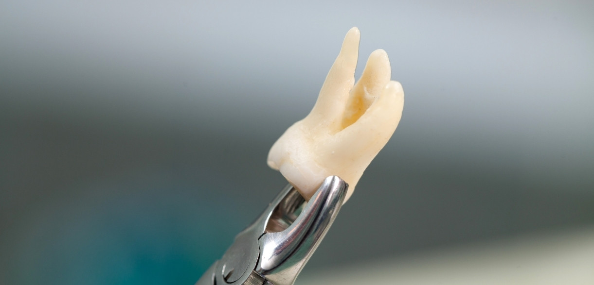 most common reasons for a tooth extraction