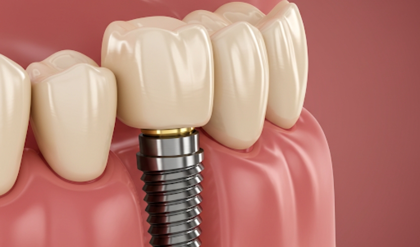 Get Dental Implants if You Have Gum Disease