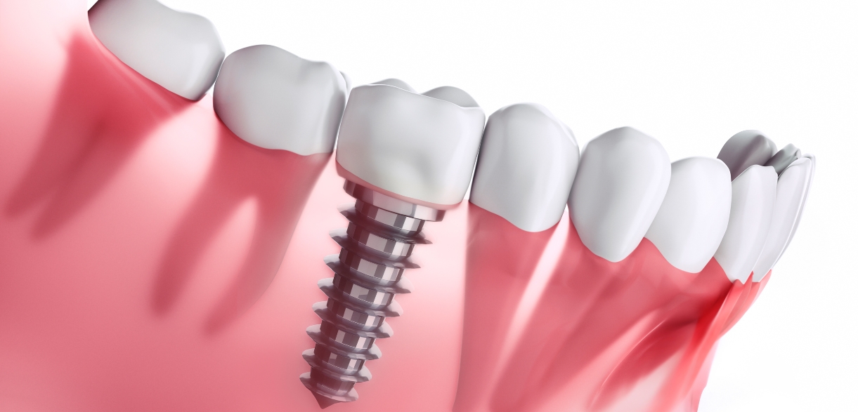 the importance of dental implant aftercare
